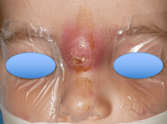 fistule DN infectée