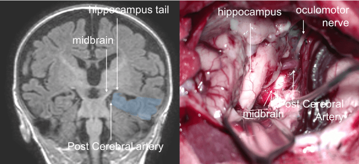 hippocampectomie 3