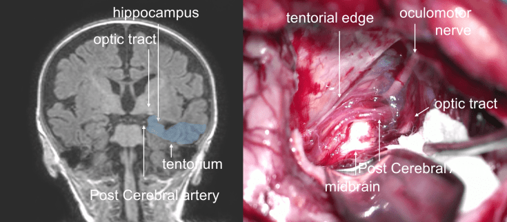 hippocampectomie 4