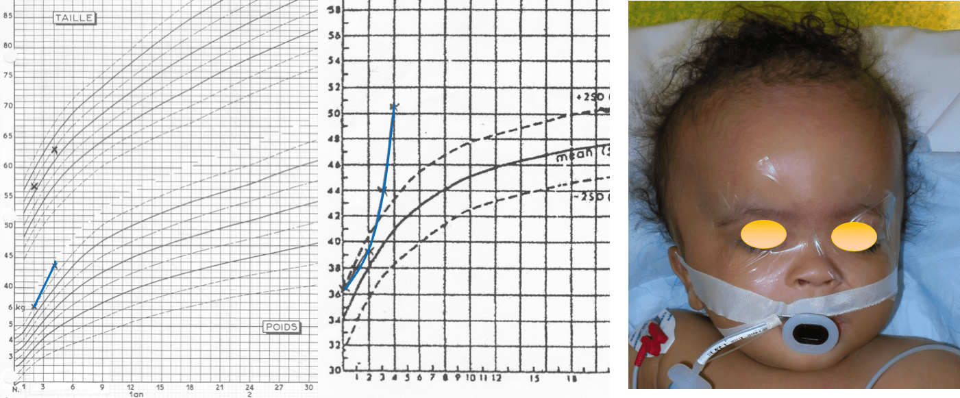 macrocéph prise de poids