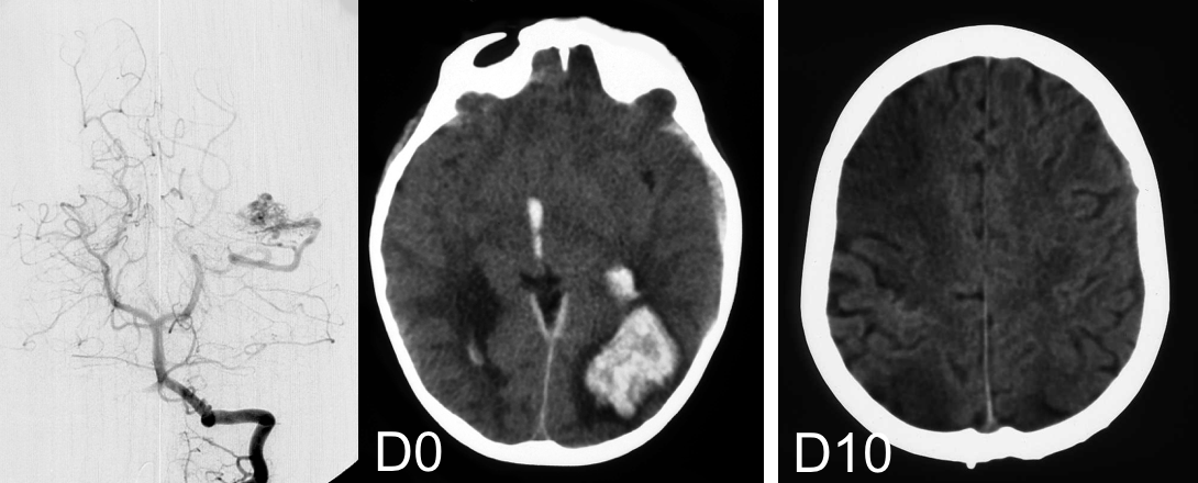 MAV spasme controlat