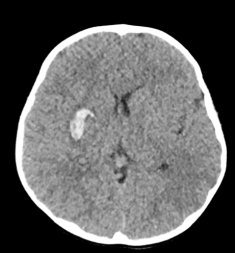 moya Hotte hémorragie