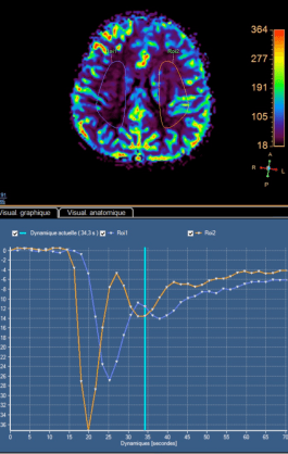 moya Hotte perfusion