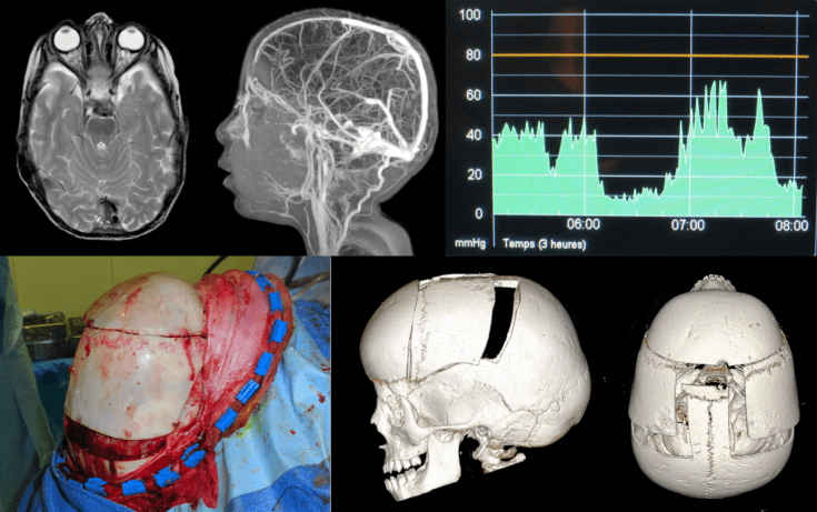 pseudotumor cranioplastie