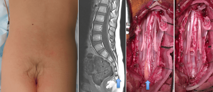 retained cord Pluquin