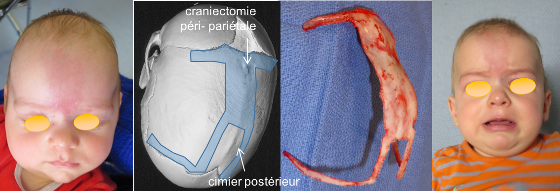 scapho craniectomie