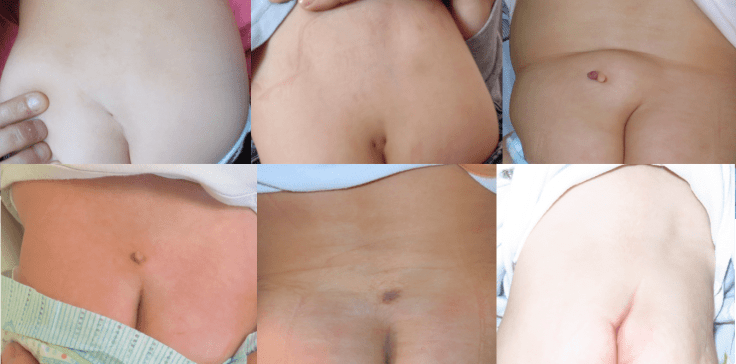 sillons atypiques moelle normale