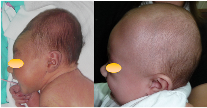 TC obstétr moulding