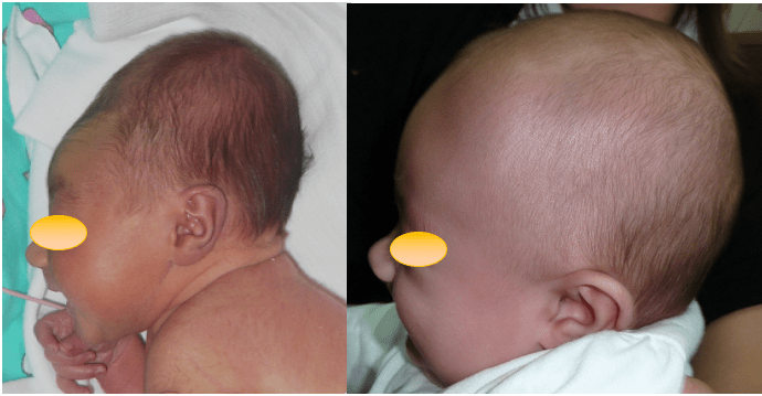 TC obstétr moulding