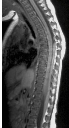 trauma rachidien maltraitance