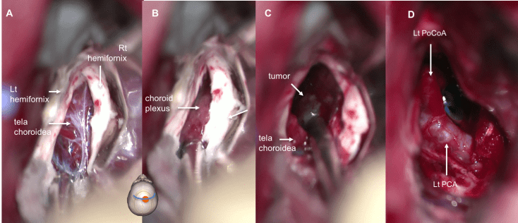 V3 interforniciale Vandevelde