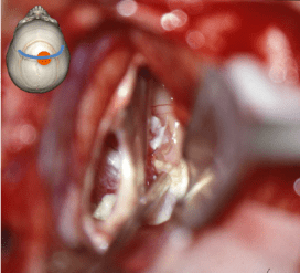 V3 transcalleux bilat