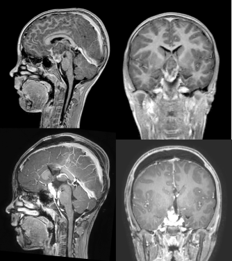 V3 Vandevelde pre-postop