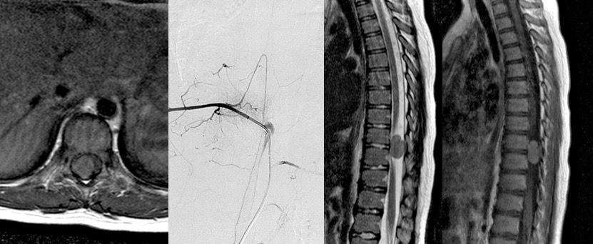 Bogaert méningiome.jpg
