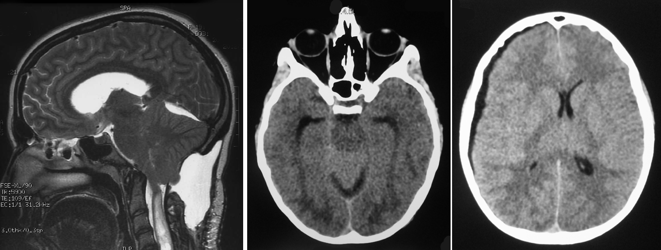 Chiari complications hydrauliques
