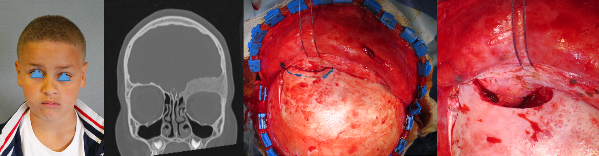 dysplasie fibreuse Bamasaoudi