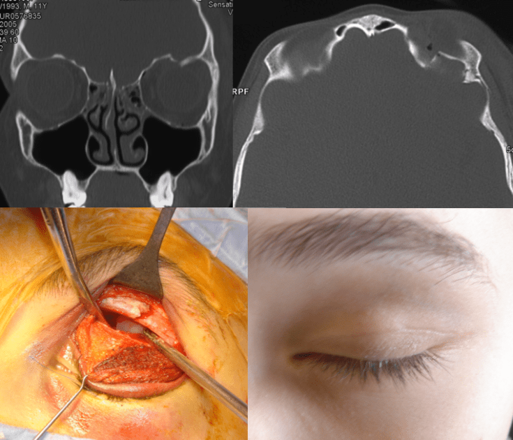 étage ant Boughlam toit d'orbite