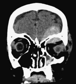 étage ant Declercqadhérence DM
