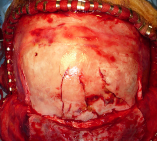 étage ant Delfosse comminutive