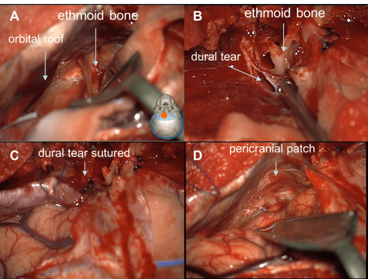 étage ant fermeture extra-durale.png