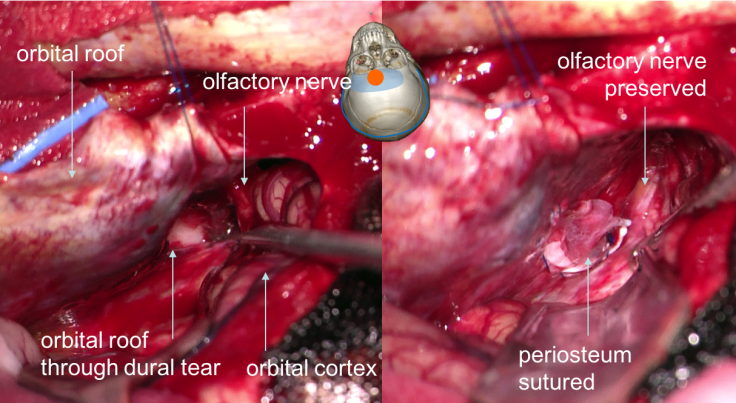 étage ant fistule Delplace perop
