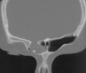 étage ant fistule tardive.png