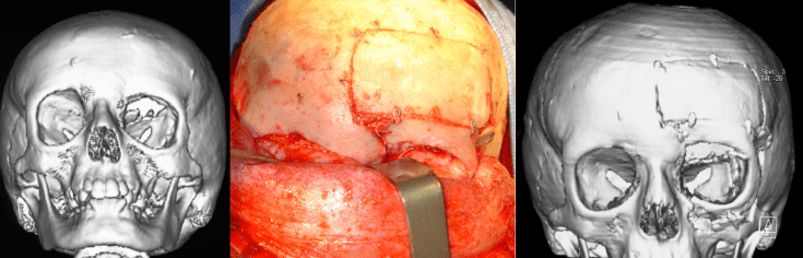 étage ant Gottrand orbitotomie