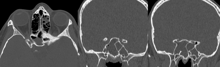 étage ant rhinorrhée paradoxale.png