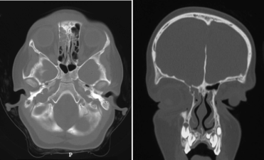étage ant sans rhinorrhée.png