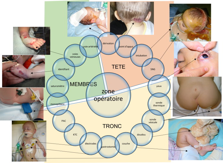 installation complications