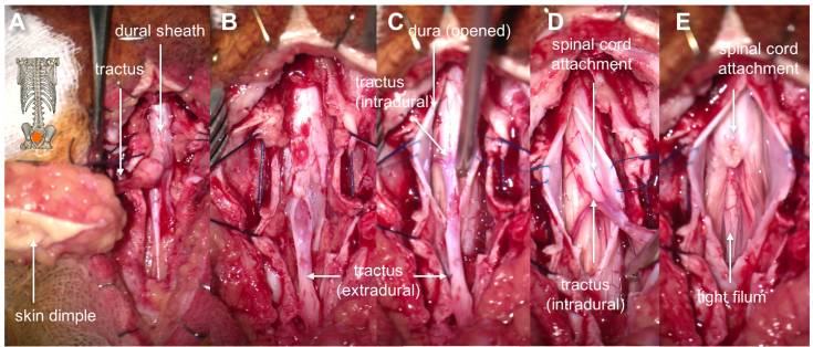 méningocèle manquée