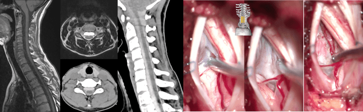 méningocèle pre-M Hoyez