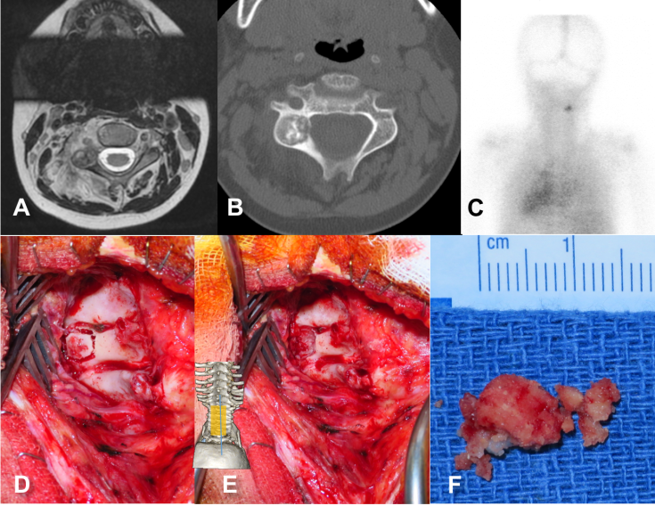 ostéome ostéoïde Cardon Boullet