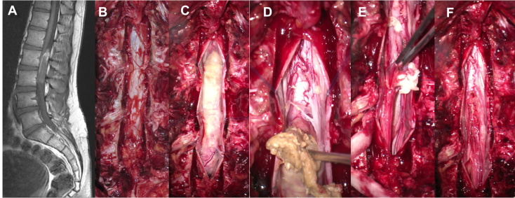 QdeCh Fevrier dermoïde