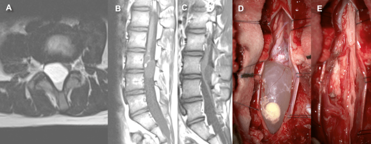 QdeCh Salat dermoïde