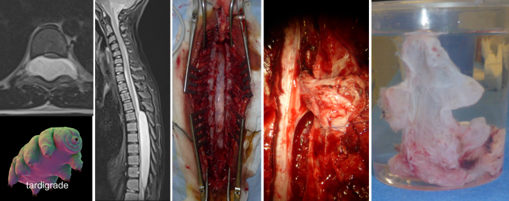 Rawash intradural.png