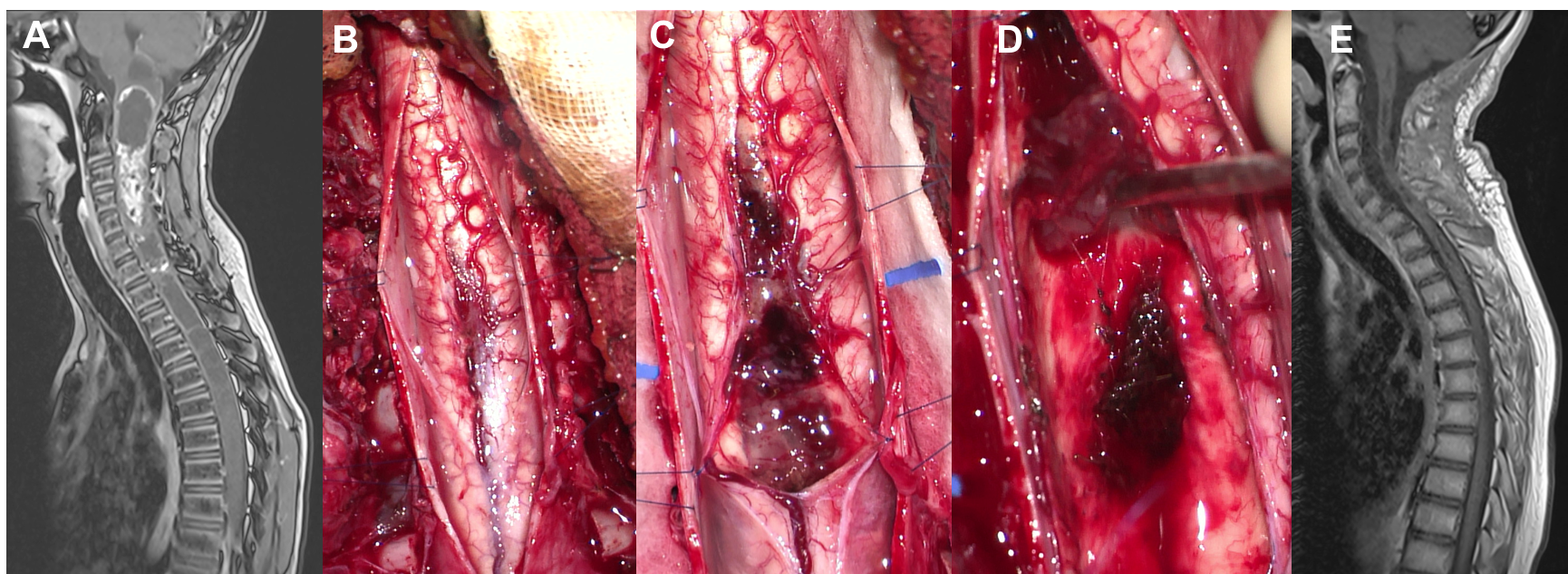 TIM épendymome Vectol