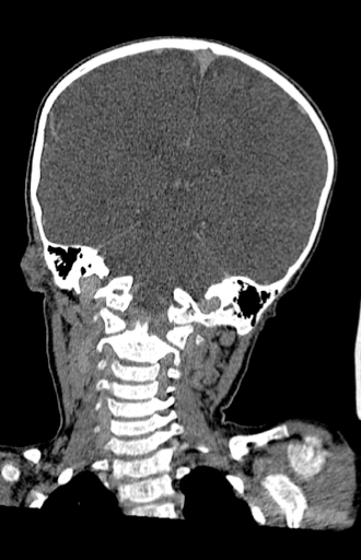 TIM torticolis non rotatoire