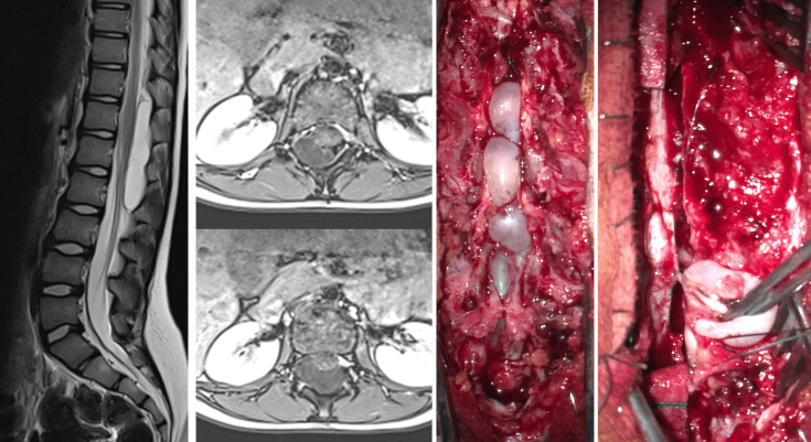 Trentesaux epidural Fox C2