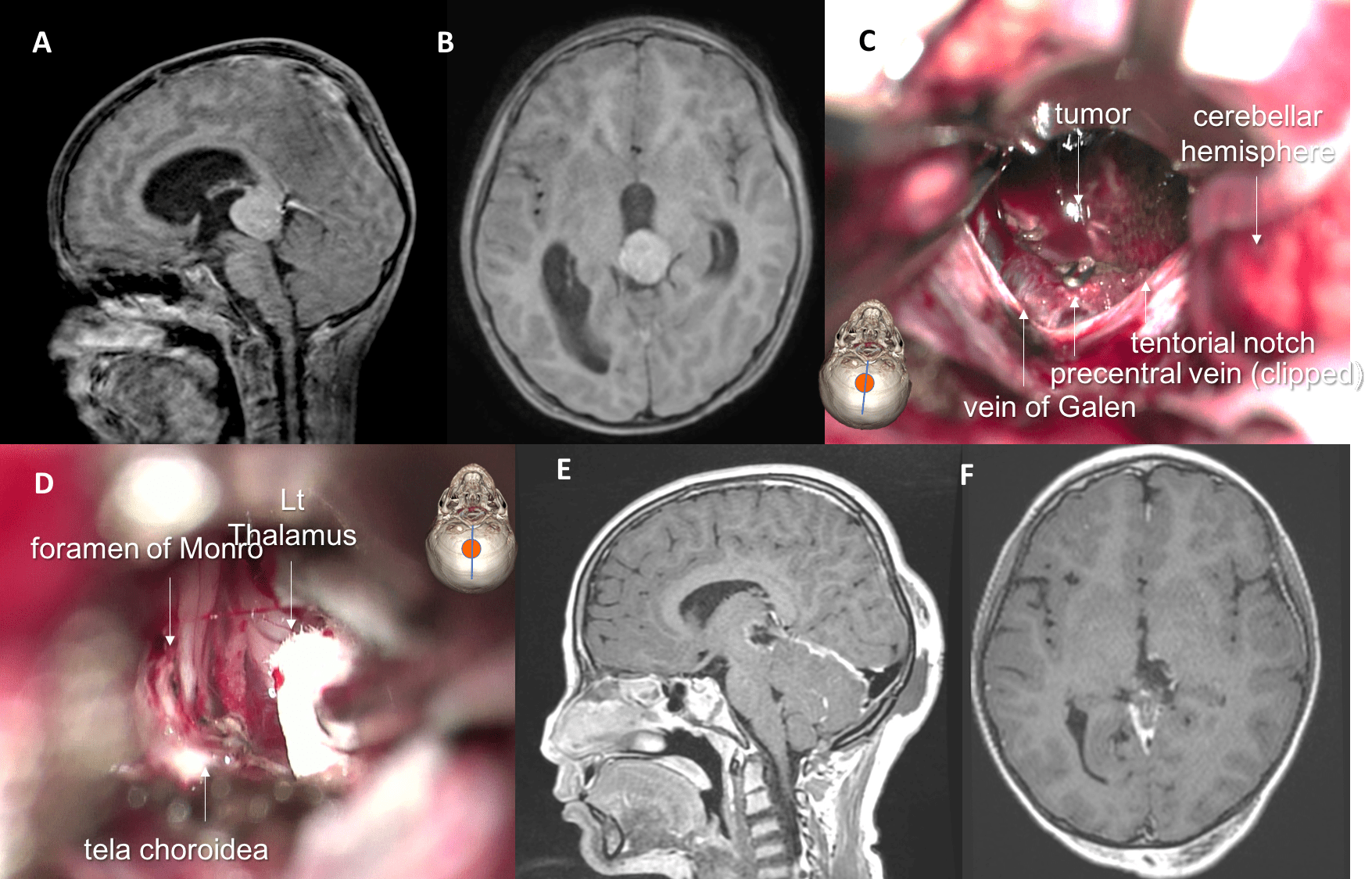 GCT by infratentorial approach